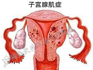 杭州正规助孕产子医院排名_子宫腺肌症的症状有哪些？