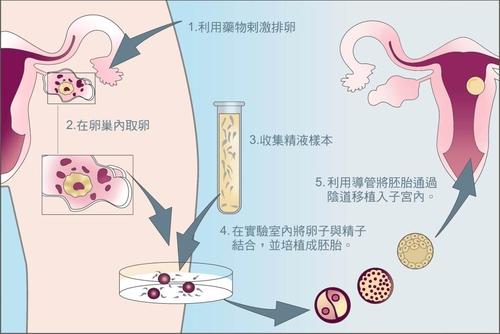 杭州龙凤胎助孕机构:在杭州进行试管婴儿治疗需要结婚证吗？