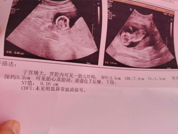 哈尔滨45岁助孕宝宝：在显示胎儿性别的超声片上，脐点在哪里？