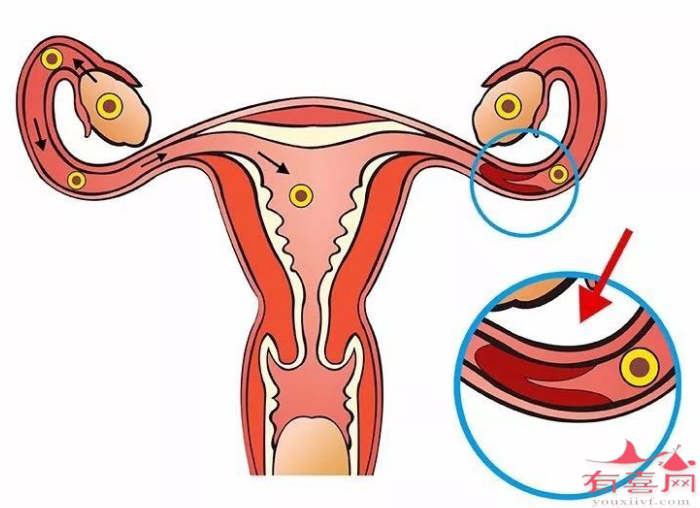 大连供卵助孕自怀-输卵管粘连如何怀孕